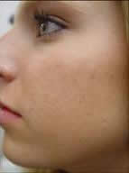 acne_treatment after